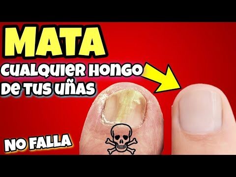 Remedios Caseros con U&ntilde;a Verde para la Salud